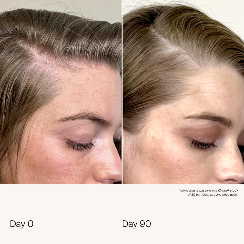 Side-by-side close-ups of a woman’s hairline and temple using Scalp Care Density Serum: Day 0 shows thinner grey hair, while Day 90 displays noticeably fuller growth. Both images are at the same angle with eyes closed.