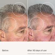 Side-by-side photos of a mans head show hair growth improvement. The left, Before, shows thinner grey hair; the right, After 90 days using Scalp Care Density Serum, reveals visibly fuller hair in circled areas.